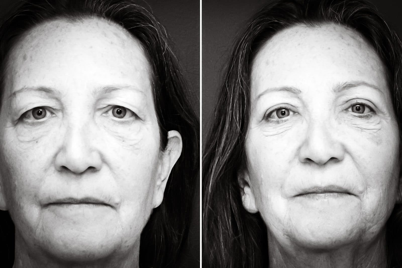 Upper blepharoplasty — before and after