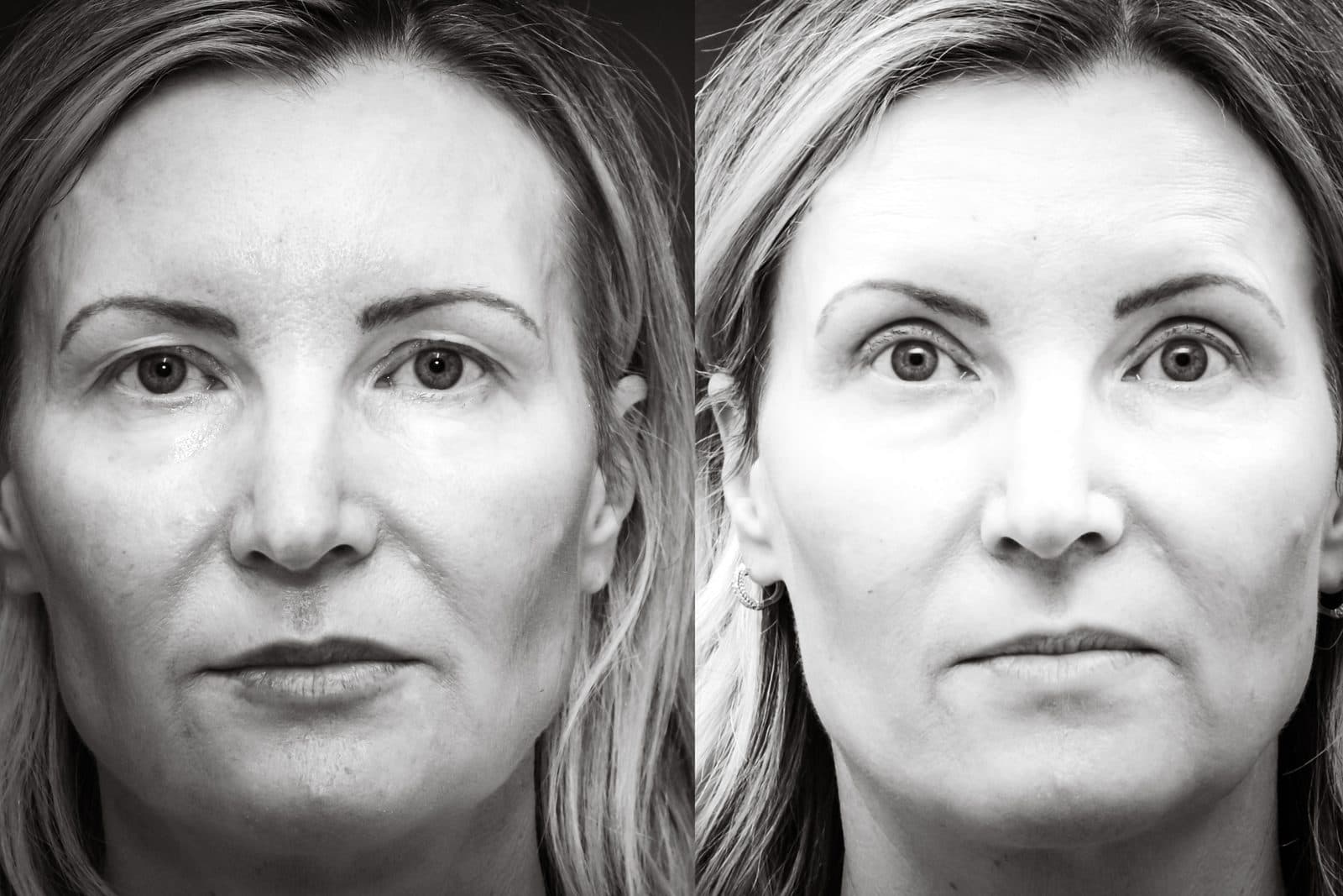 Upper blepharoplasty — before and after