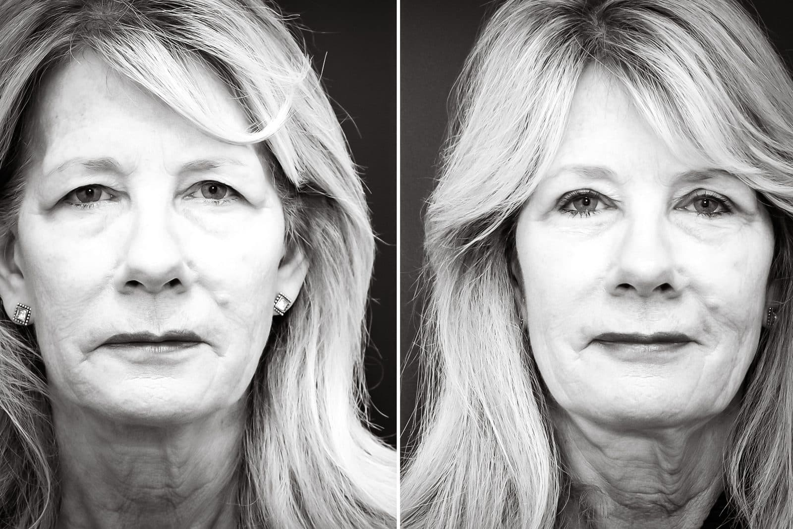 Upper blepharoplasty — before and after