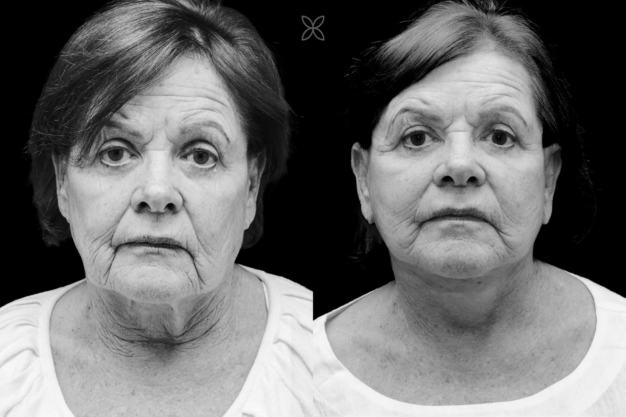 Facelift & neck lift — before and after