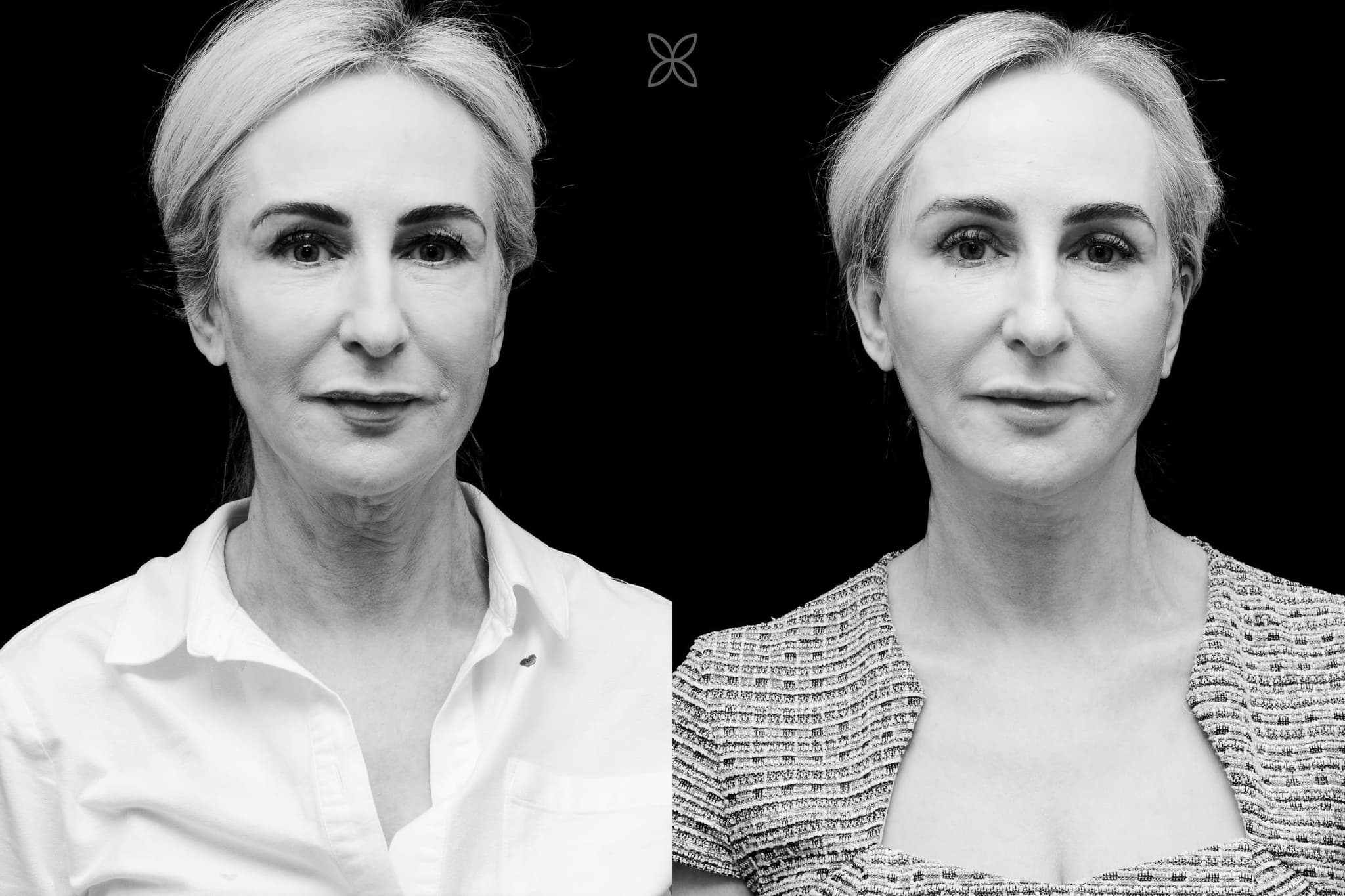 Facelift & neck lift — before and after