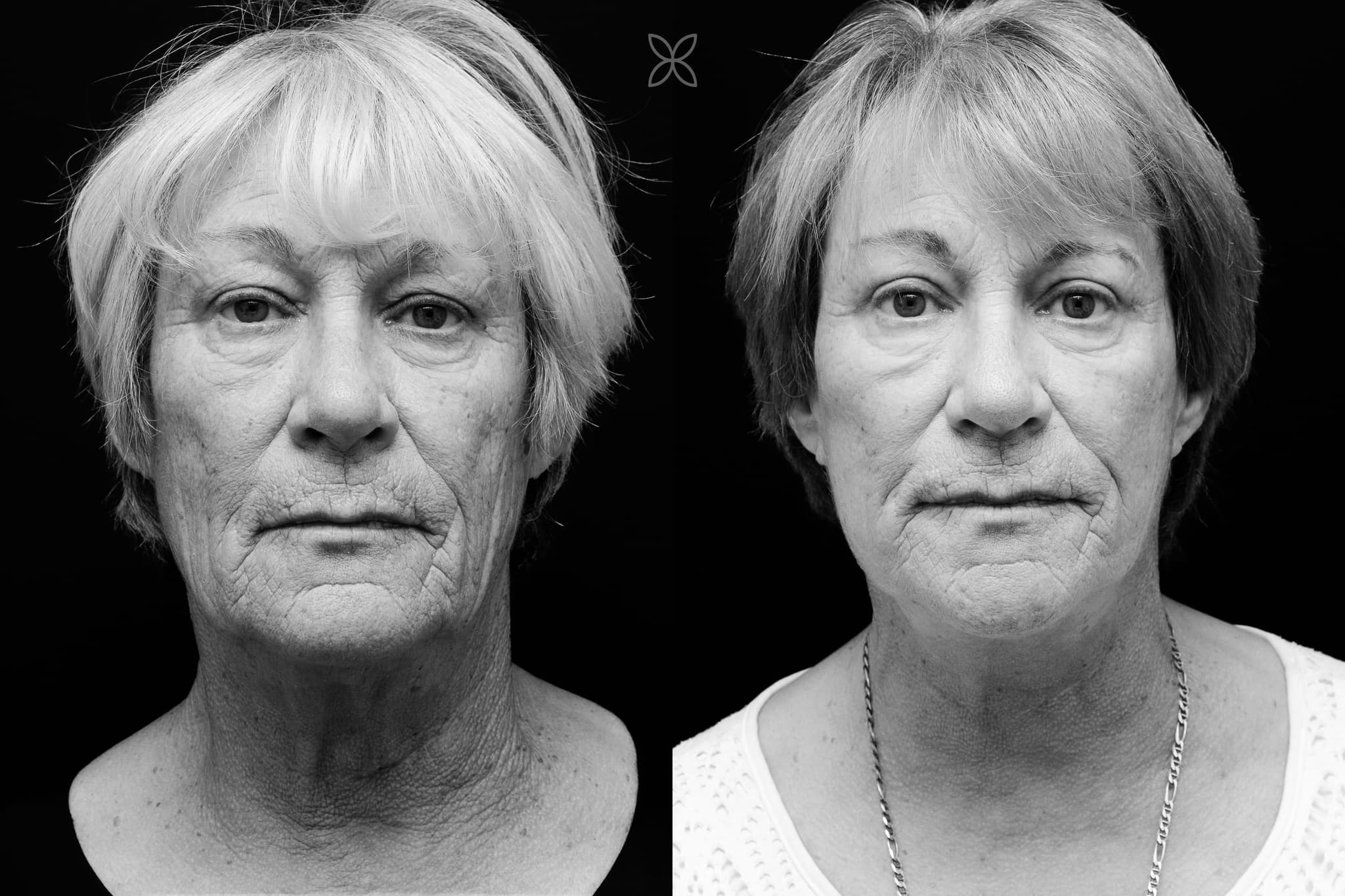 Facelift & neck lift — before and after