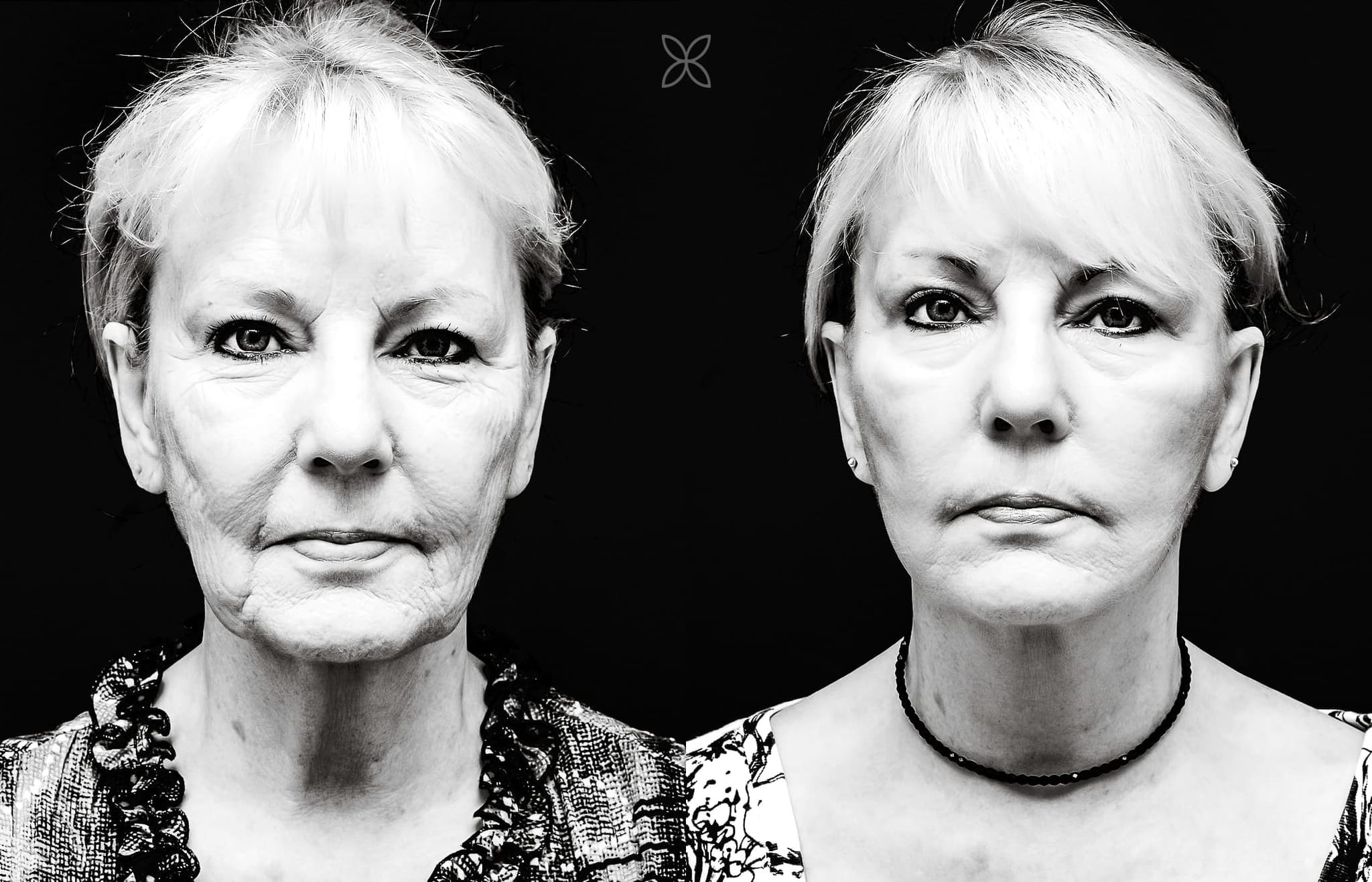 Facelift & neck lift — before and after