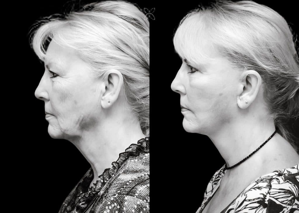 Facelift & neck lift — before and after