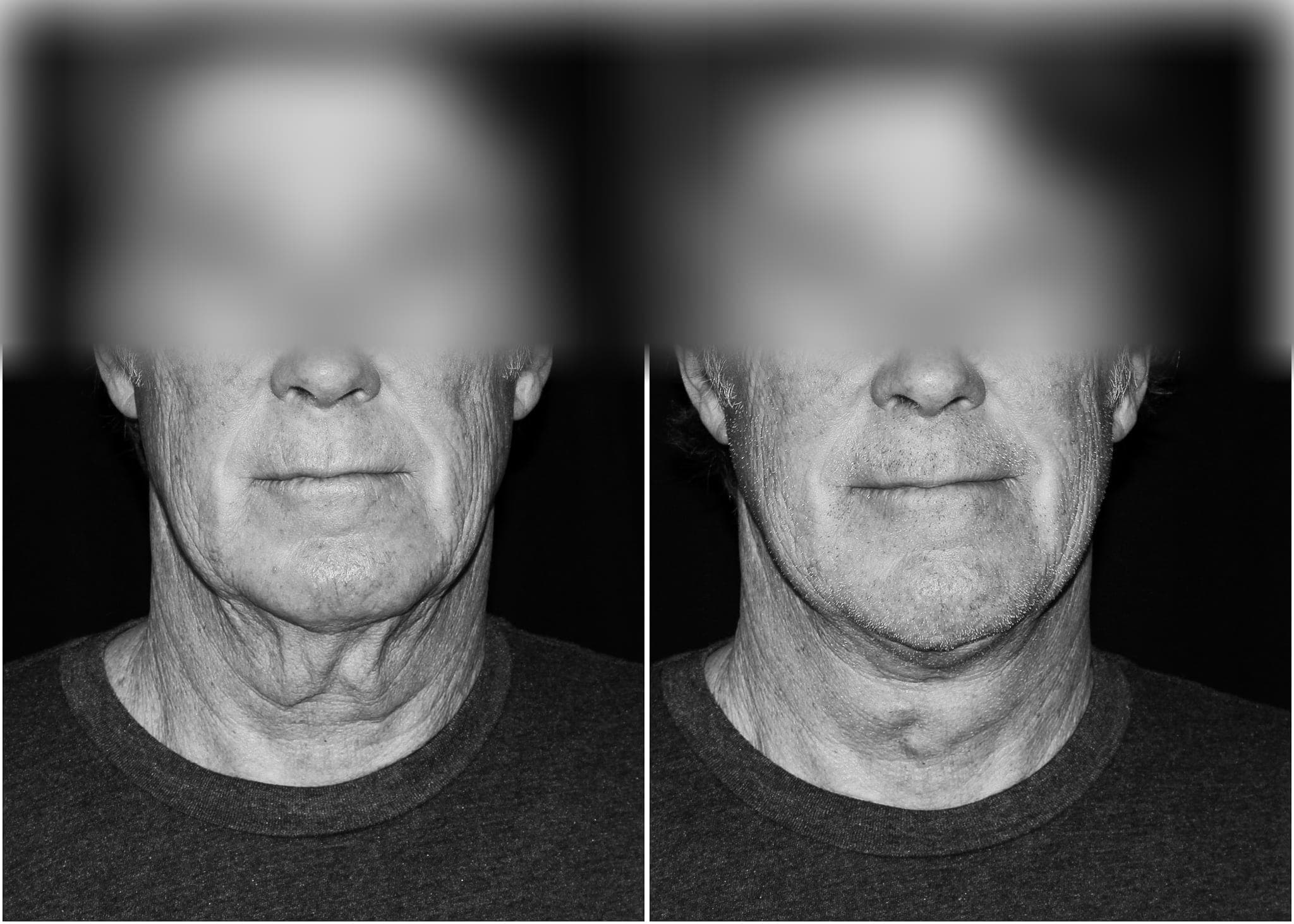 Neck lift — before and after